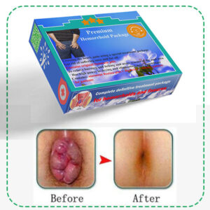 پماد برای زائده گوشتی و درمان بواسیر خارجی با استفاده از پک ممتاز خارجی مرسی درمان