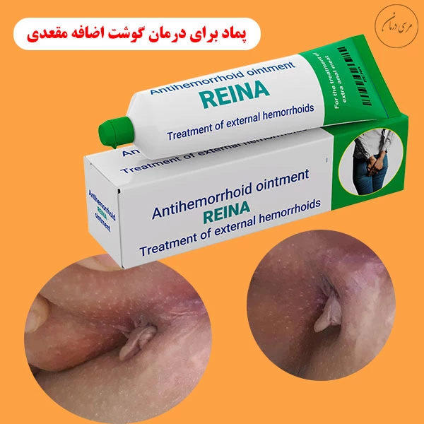 پماد برای درمان گوشت اضافه مقعدی