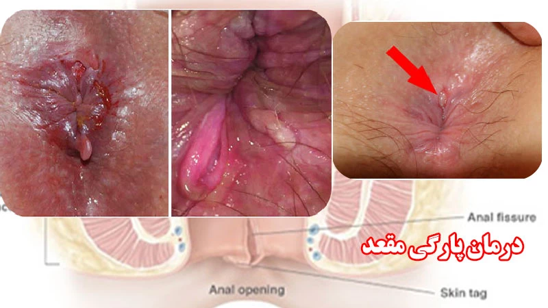 پارگی مقعد یا پارگی رکتوم درمان خانگی پارگی مقعد با پماد گیاهی رینا