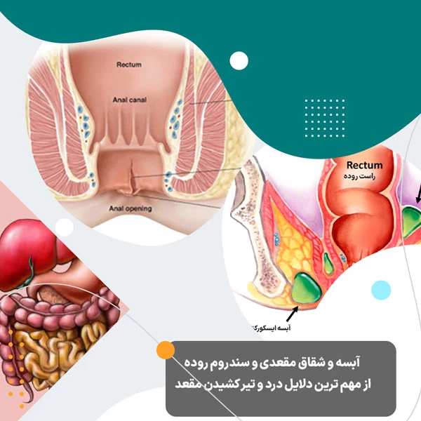 علت درد مقعدی بعد از مدفوع ناشی از بیماری شقاق یا آبسه مقعدی است