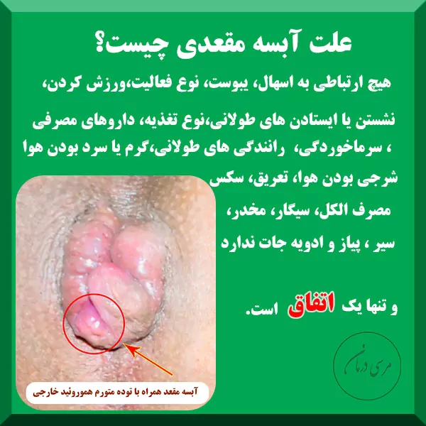 علت آبسه مقعدی چیست
