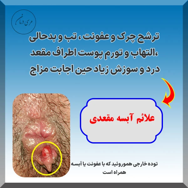 علائم آبسه مقعدی چیست معمولا با درد و تب و ترشح چرک و عفونت خود را نشان میدهد