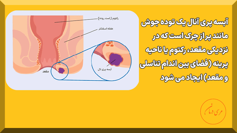 آبسه مقعدی چیست آبسه مقعدی حاصل تجمع عفونت در بافت زیر پوست مقعد است