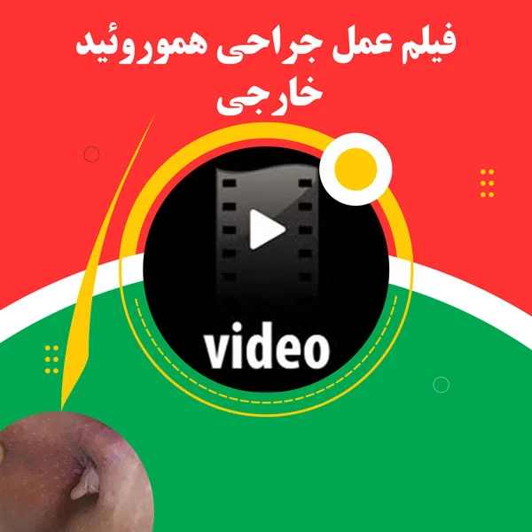 فیلم درمان گوشت اضافه مقعدی با لیزر