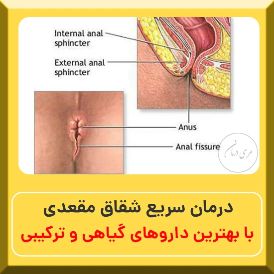 درمان شقاق مقعدی