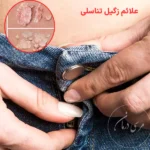 علائم زگیل تناسلی