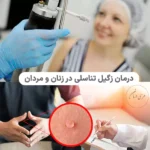 درمان زگیل تناسلی