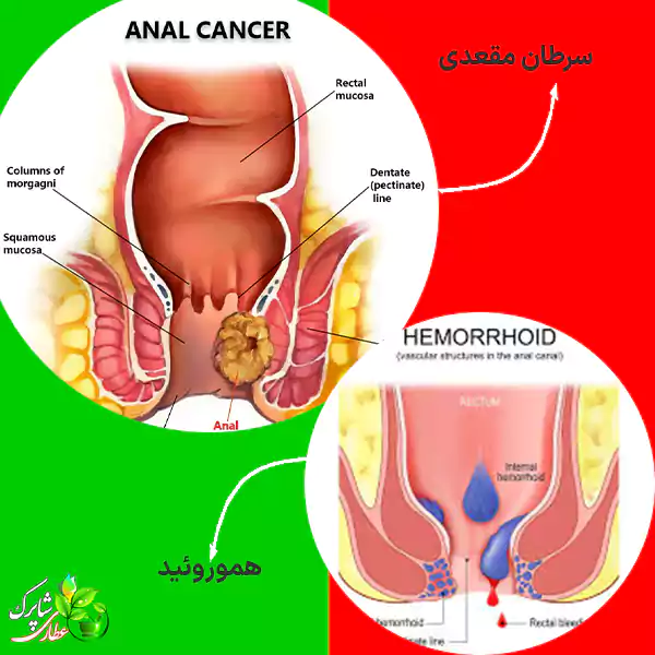 تفاوت بواسیر و سرطان مقعدی ؛هر دو بیماری، ناحیه مقعد – بخش انتهایی دستگاه گوارش – را درگیر می‌کنند؛ و می‌توانند علائمی نظیر خونریزی، خارش، درد و احساس توده ایجاد نمایند