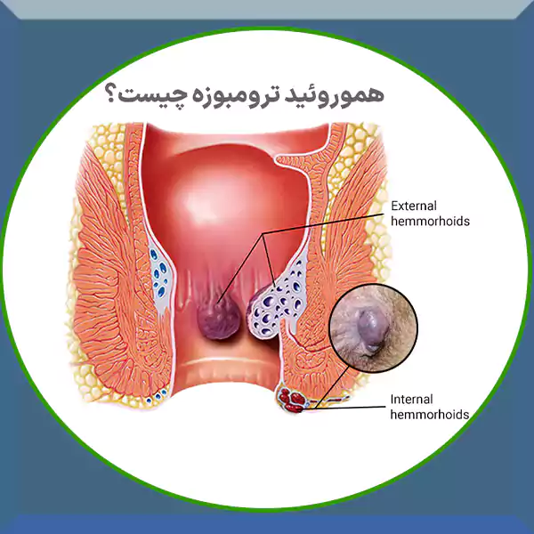 هموروئید ترومبوزه چیست پرسشی است که معمولاً پس از شروع ناگهانی درد شدید، تورم سفت و ناراحتی غیرقابل‌تحمل در ناحیه مقعد مطرح می‌شود.