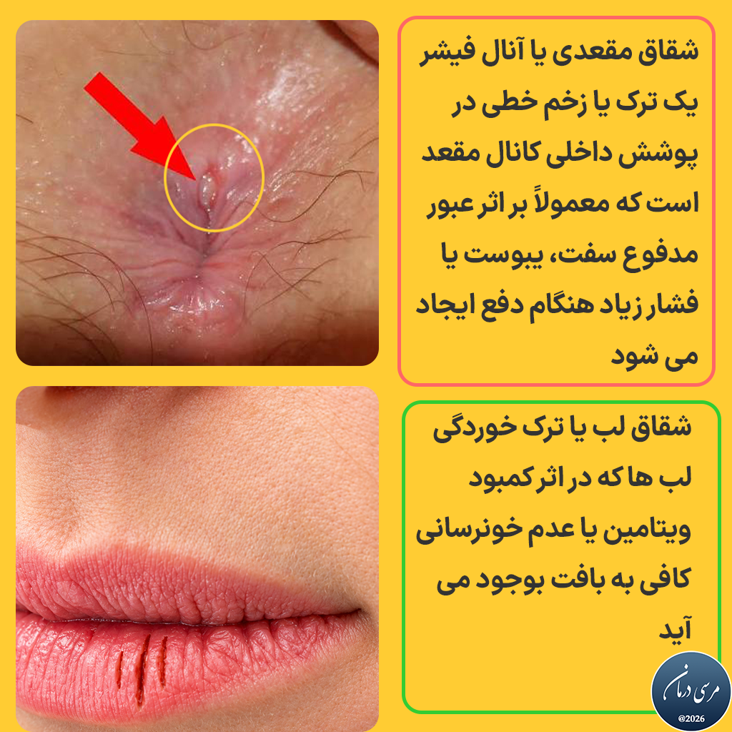 شقاق مقعدی چیست شقاق مقعدی به ترک یا زخم کوچکی در بافت پوشاننده کانال مقعد گفته میشود